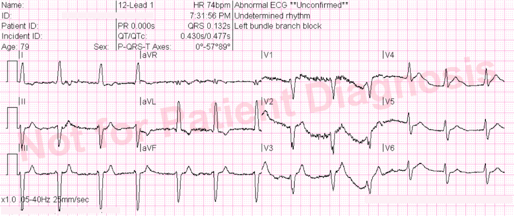 79 year old with chest pain