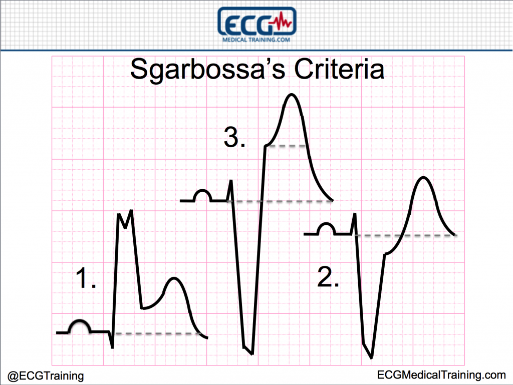 Sgarbossa's Criteria