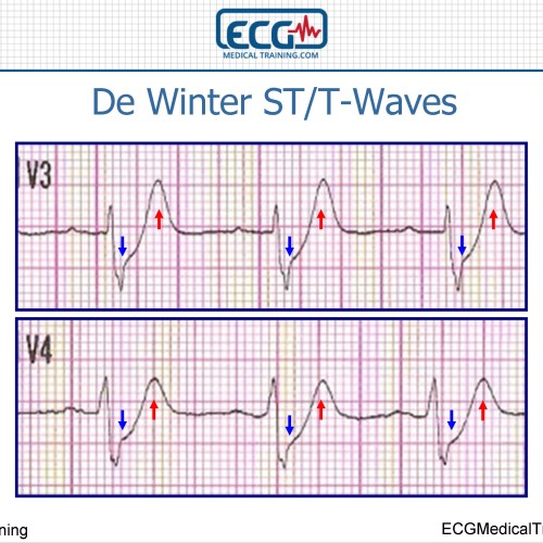 De Winter ST/T-Waves