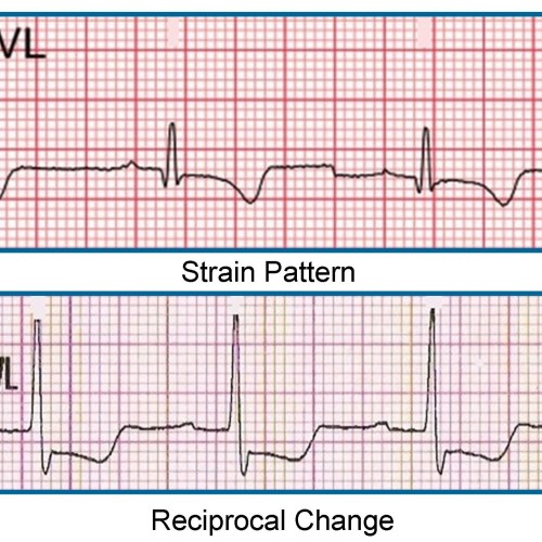 Importance of Lead aVL in STEMI Recognition