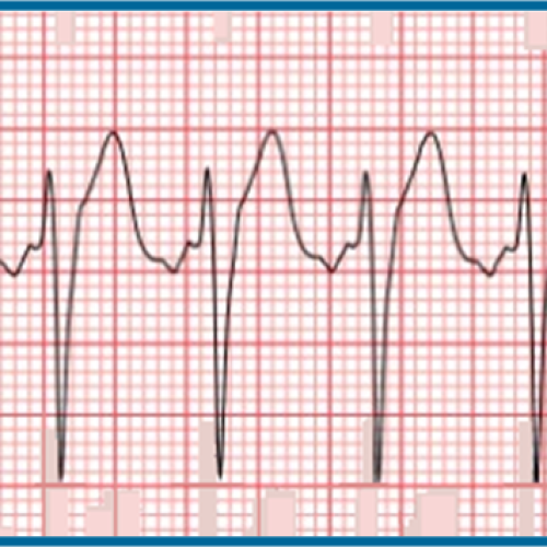 Usefulness of the QRS/T angle when diagnosing acute STEMI