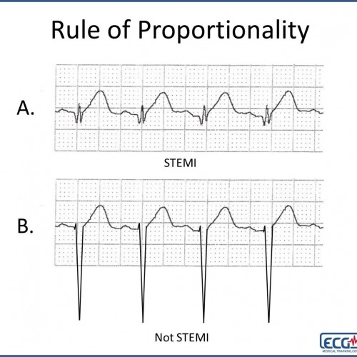 When Acute Anterior STEMI Does Not Meet Guidelines